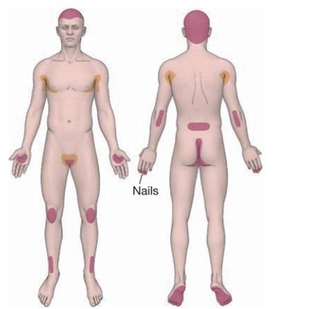 银屑病是什么样的病症,银屑病是免疫系统疾病