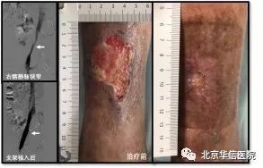 糖尿病腿部褥疮溃烂怎么办,专治糖尿病褥疮