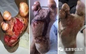 糖尿病腿部褥疮溃烂怎么办,专治糖尿病褥疮