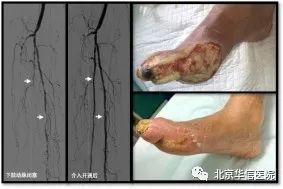 糖尿病腿部褥疮溃烂怎么办,专治糖尿病褥疮