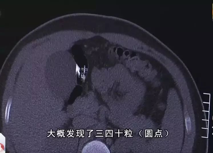 13岁男孩喝珍珠奶茶引发的案例,男孩喝珍珠奶茶腹痛