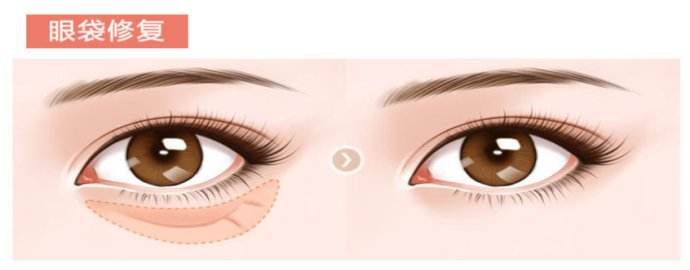 眼袋下面的脂肪粒该怎么去除,眼袋上的脂肪粒怎么去掉