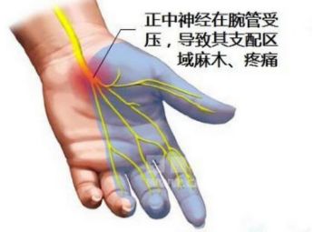 手腕没有劲握不住拳是什么病,腕管综合征手腕积液最快怎么消除