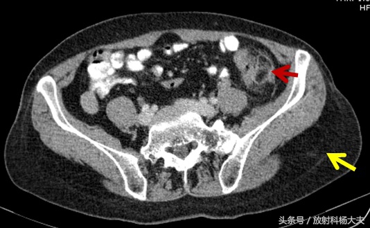 女孩肚子下腹部隐隐作痛做肠镜,女性腹部胀痛检查也没什么