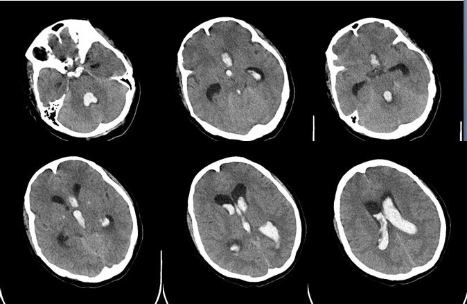 天新福-百家百言｜前交通动脉瘤再出血一例