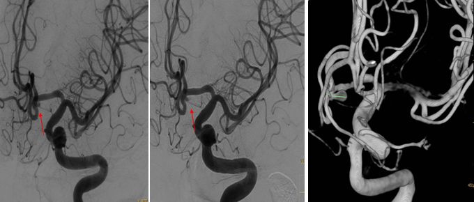 天新福-百家百言｜前交通动脉瘤再出血一例