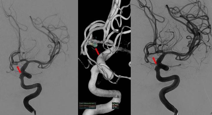 天新福-百家百言｜前交通动脉瘤再出血一例