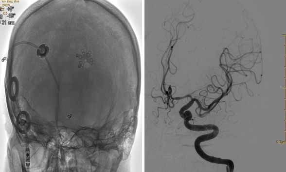 天新福-百家百言｜前交通动脉瘤再出血一例