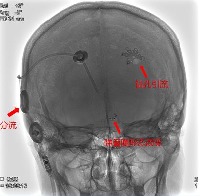 天新福-百家百言｜前交通动脉瘤再出血一例