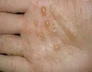 手上长小水泡需不需要把它挑破,夏天手上起小水泡吃什么中药治疗