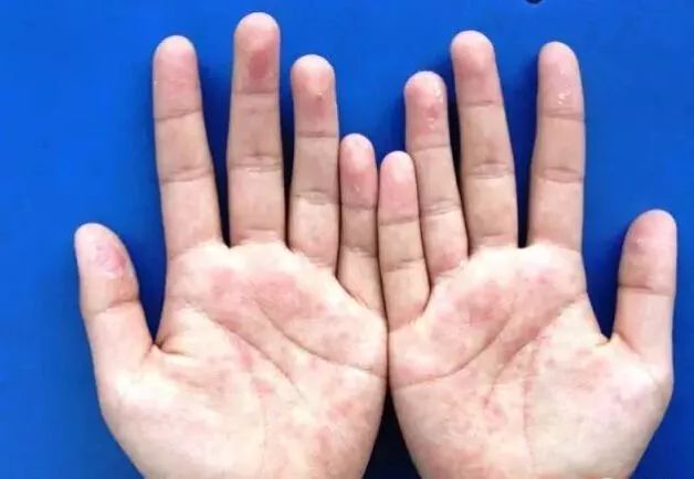 手上长小水泡需不需要把它挑破,夏天手上起小水泡吃什么中药治疗