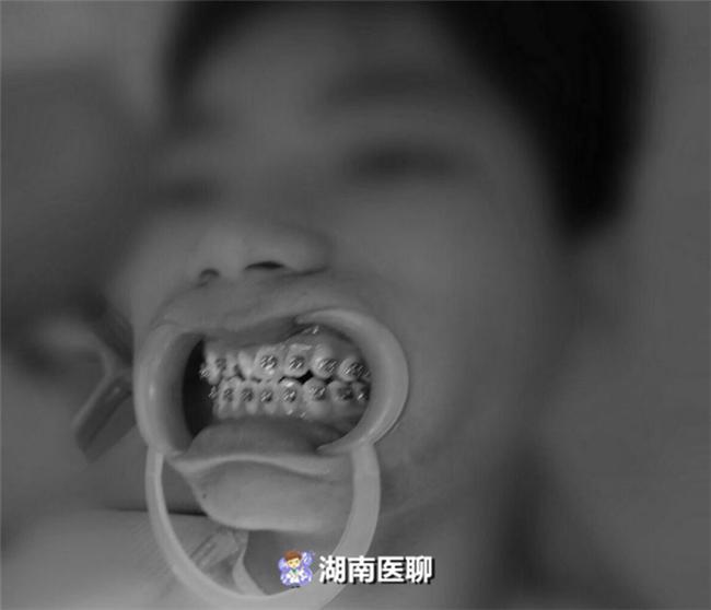 7岁孩子牙齿正畸的真实感受,牙套的诱惑