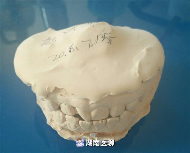 7岁孩子牙齿正畸的真实感受,牙套的诱惑