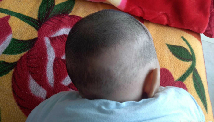 宝宝轻微鸡胸医生让吃5粒d3,宝宝体检医生说宝宝有点鸡胸咋办