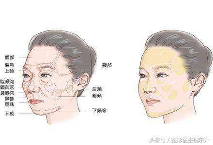 浅谈面部五层提升为什么能更好的解决面部松弛下垂