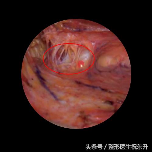 浅谈面部五层提升为什么能更好的解决面部松弛下垂