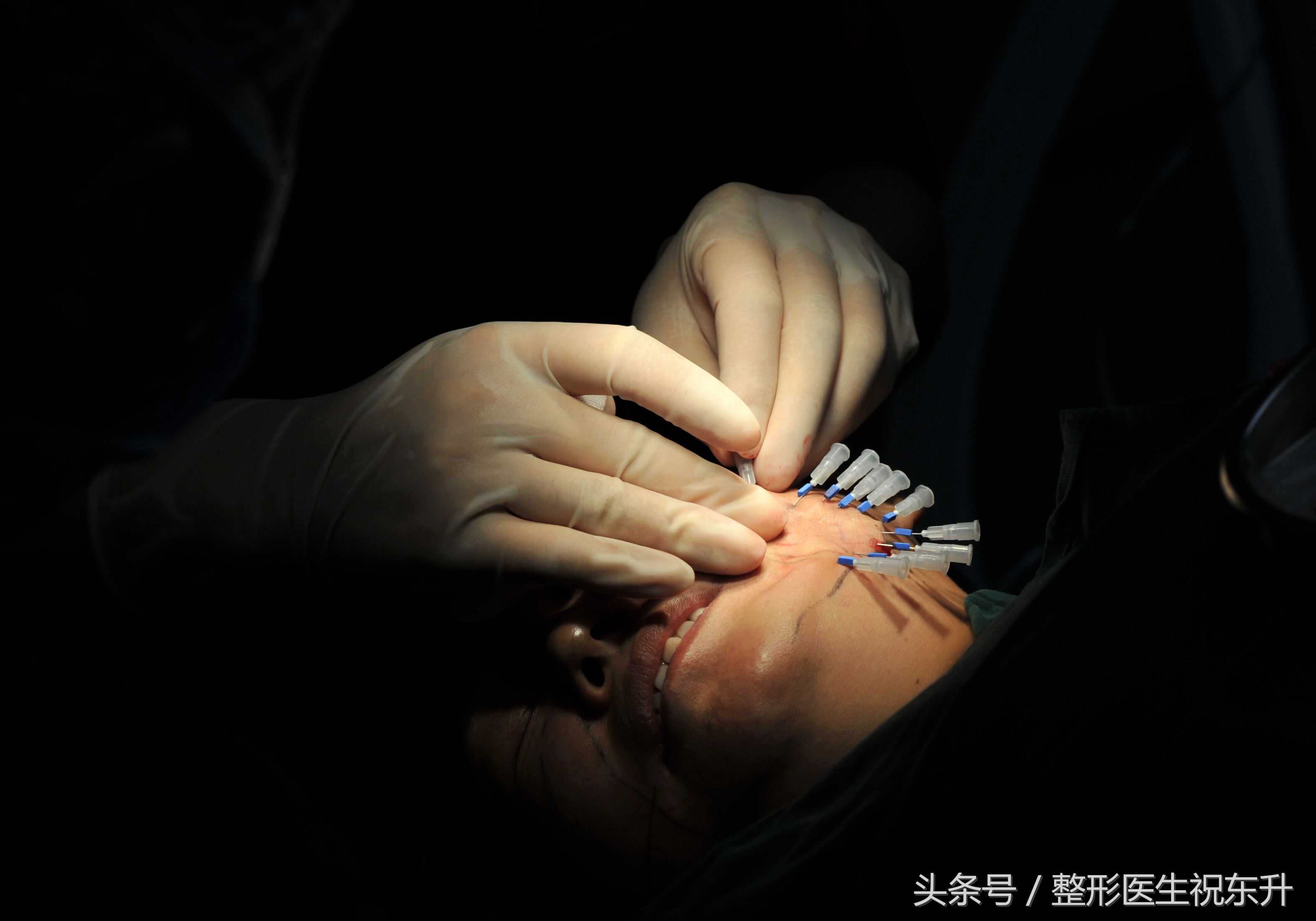 浅谈面部五层提升为什么能更好的解决面部松弛下垂