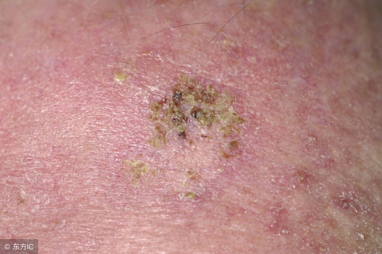 皮肤溃烂反复无法愈合癌症,皮肤溃烂伤口不愈合挂什么科