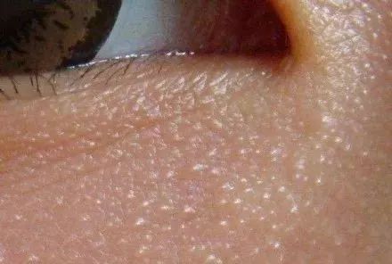 脂肪粒原来是这么来的,关于脂肪粒的小知识