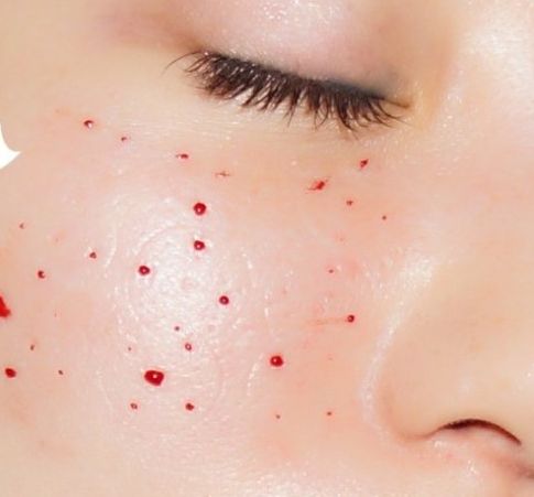 水光针涂抹式精华液人气版,有一种水光针是涂抹式的好不好