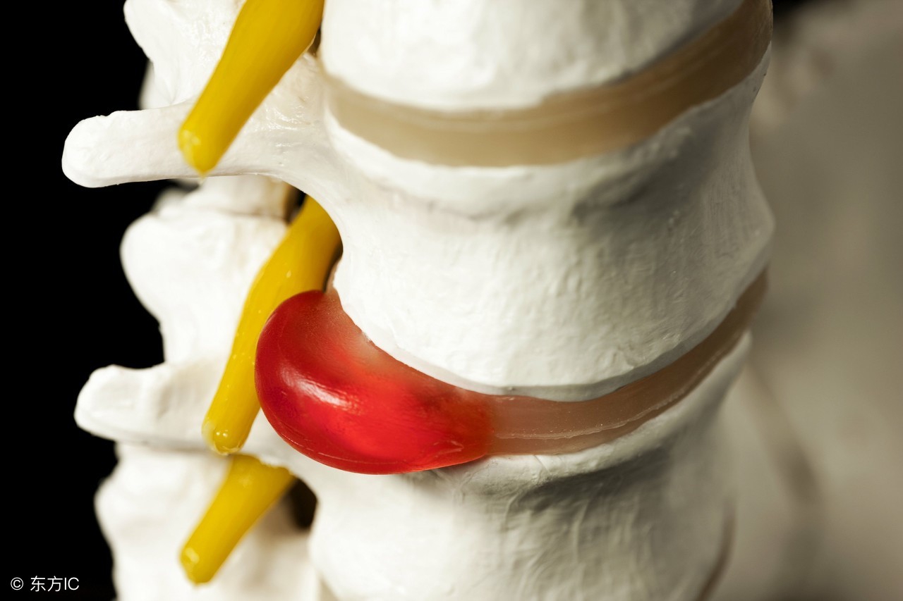 腰间盘膨出、突出、脱出有什么不同？骨科医生靠它来区分！