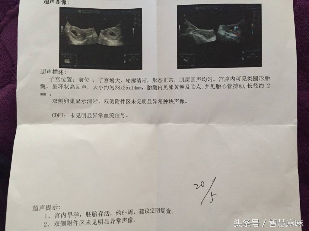 孕7周没有胎心胎芽胎停什么原因,孕7周未见胎心胎芽