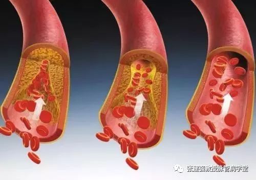 「杏林微科普」暴雨天,外出蹚水淋雨,小心得了脉管炎!