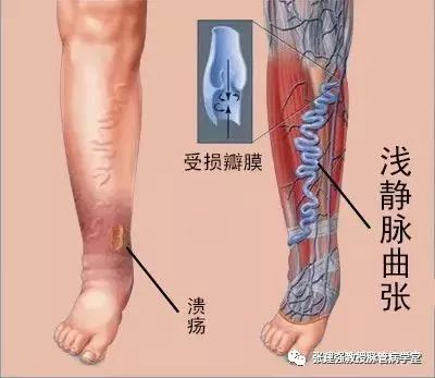 「杏林微科普」暴雨天,外出蹚水淋雨,小心得了脉管炎!