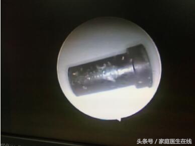 耳朵里掏异物,孩子耳朵进了东西怎么解决