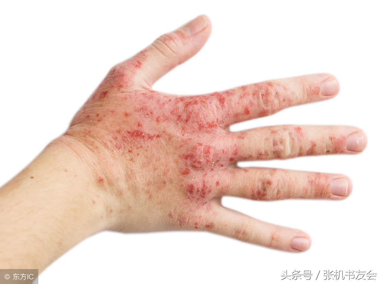 名医董洪涛讲授中医治疗皮肤病心得