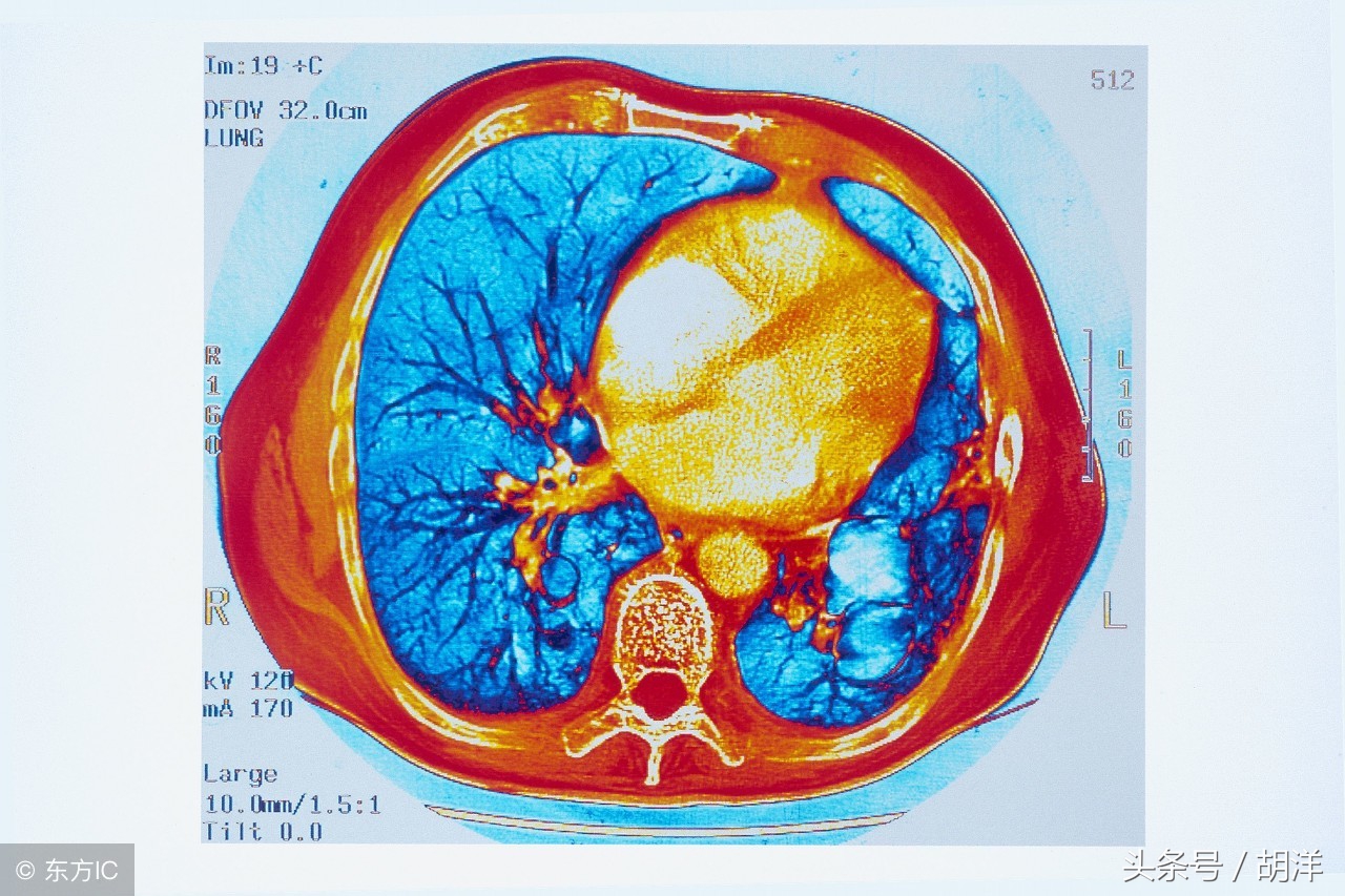 囊肿会不会转为癌症,囊肿会不会转变成癌症