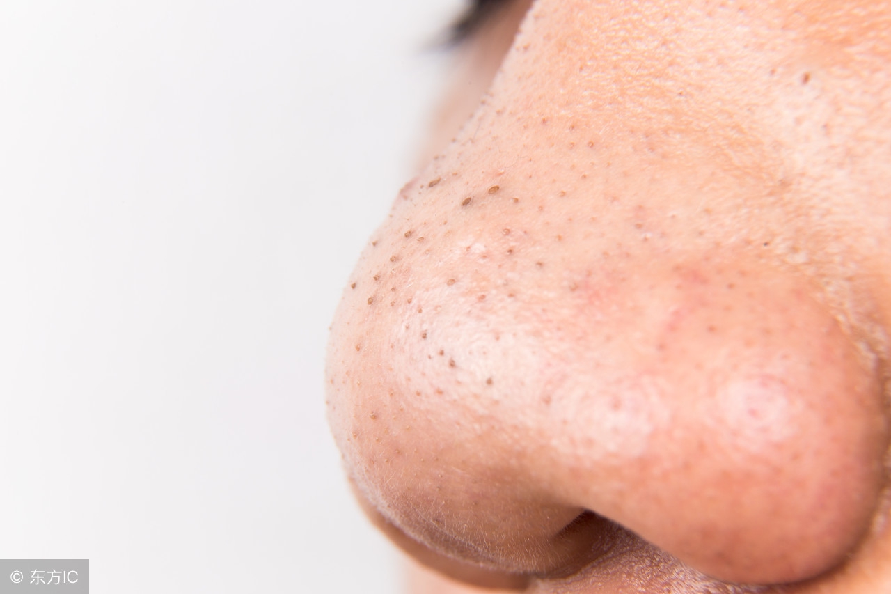 鼻子上的黑头挤压过程,鼻子上黑头怎么去掉学生