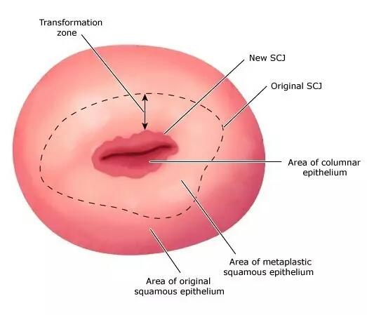 宫颈光滑就代表没有炎症吗,绝经后出血且宫颈光滑是宫颈癌吗