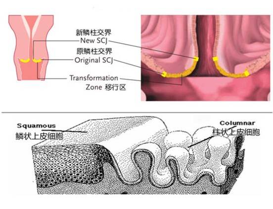 宫颈光滑就代表没有炎症吗,绝经后出血且宫颈光滑是宫颈癌吗