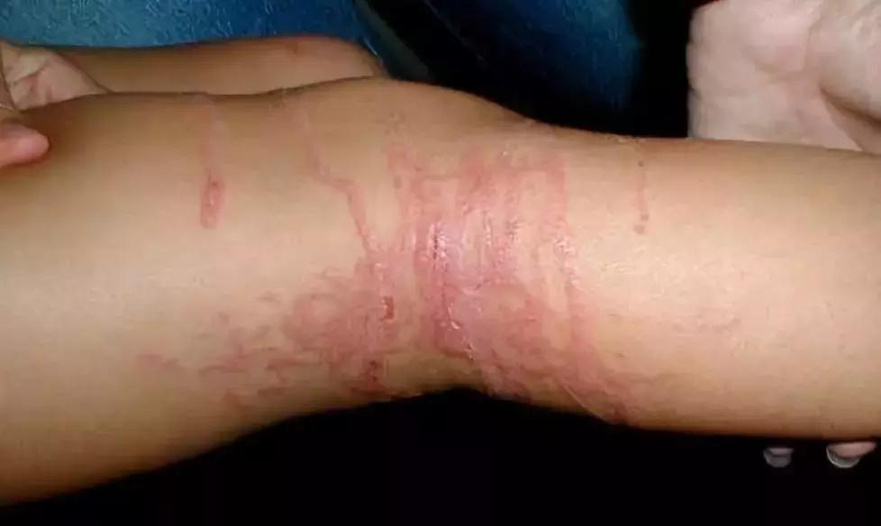 疼痛10大等级哪一级泪流满面,疼痛等级一百级分别都是什么