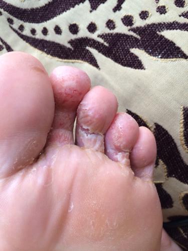 这种疾病还是防不胜防，公共场合尤其重要，臭熏天气