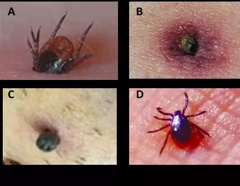 西安蜱虫叮咬去哪里治疗,疾控重要提醒户外警惕蜱虫