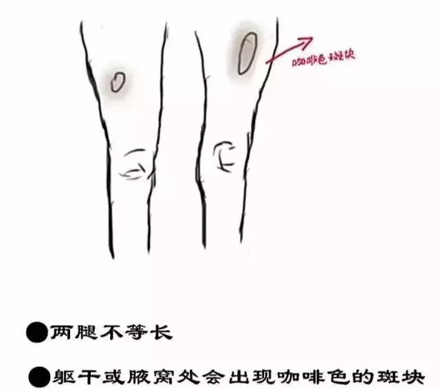 23岁姑娘撩起上衣，妈妈一看急疯了！暑假孩子一窝蜂看这病，再晚要吃大苦头！