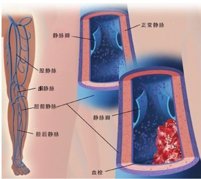 孕妇腿疼未必是缺钙,孕妇腿疼盆骨疼是缺钙吗
