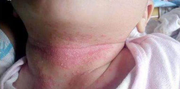 宝宝长痱子了要怎么办,宝宝已经起痱子了怎么办
