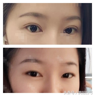 双眼皮埋线的亲身经历,对要做双眼皮埋线的几个建议