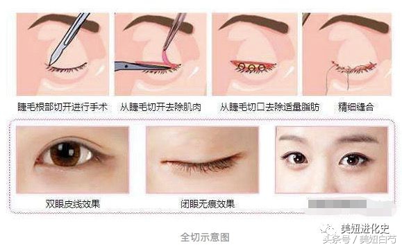 双眼皮埋线的亲身经历,对要做双眼皮埋线的几个建议