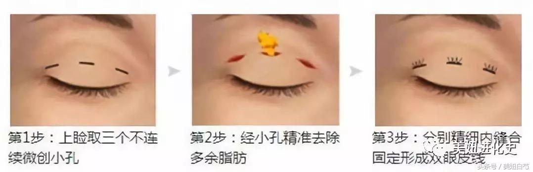 双眼皮埋线的亲身经历,对要做双眼皮埋线的几个建议