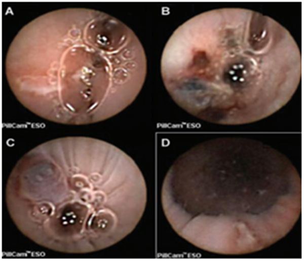「房颤专项能力培训第3期」许静:心房食管瘘的预防、早期发现及处理