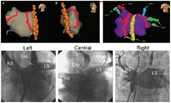 「房颤专项能力培训第3期」许静:心房食管瘘的预防、早期发现及处理