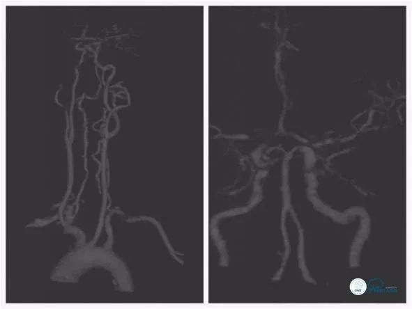 天坛脑血管动脉瘤介入手术,天坛医院脑动脉狭窄