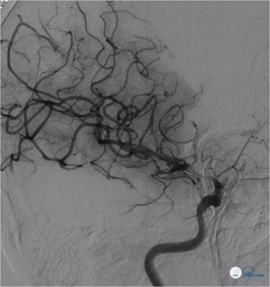 天坛脑血管动脉瘤介入手术,天坛医院脑动脉狭窄