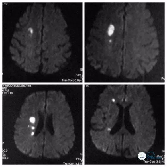 天坛脑血管动脉瘤介入手术,天坛医院脑动脉狭窄