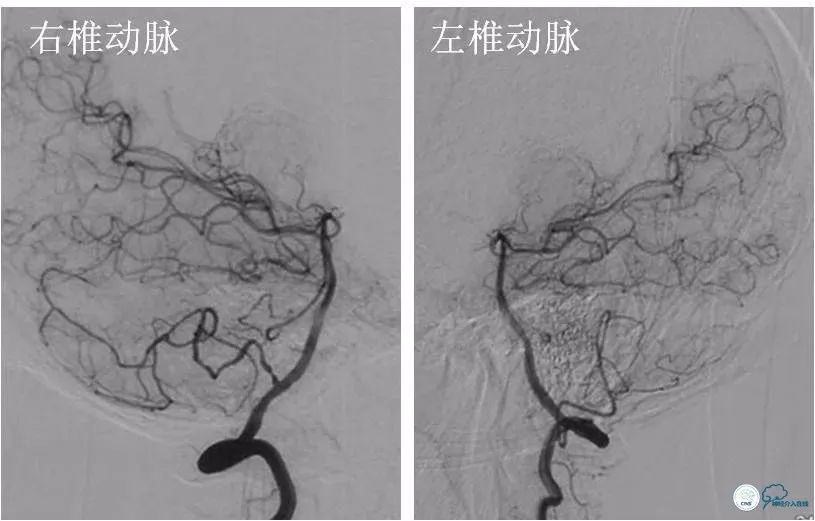 天坛脑血管动脉瘤介入手术,天坛医院脑动脉狭窄