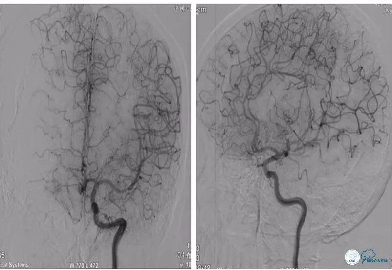 天坛脑血管动脉瘤介入手术,天坛医院脑动脉狭窄